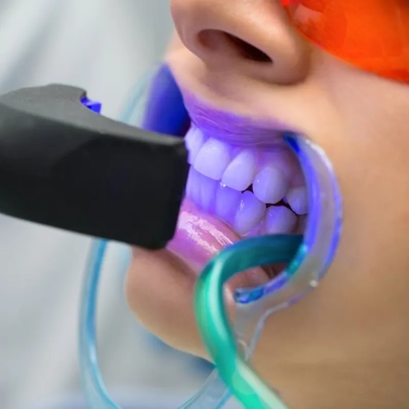 Blanqueamiento Dental