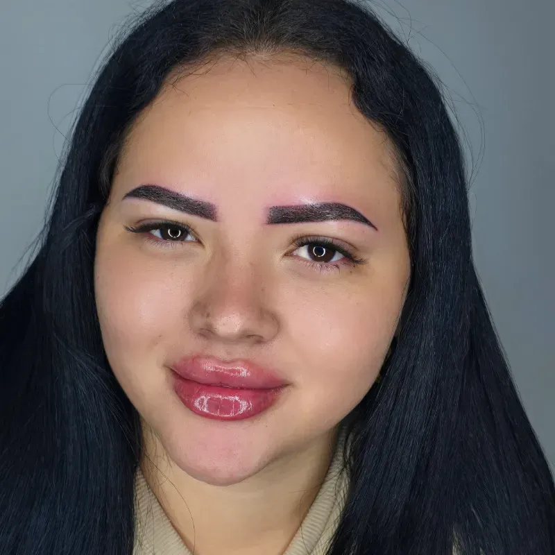 Aumento de labios