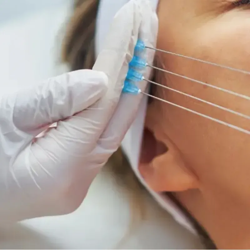 Hilos Tensores Espiculados