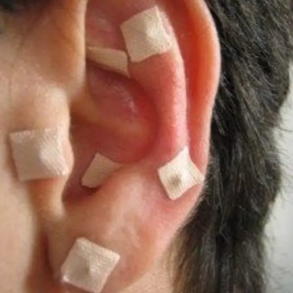 Auriculoterapia