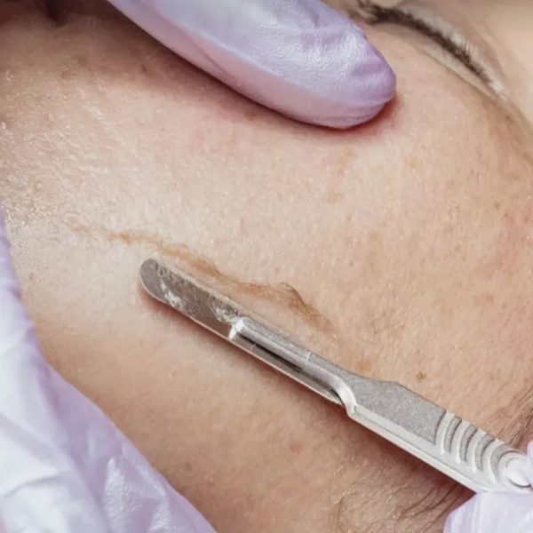 Dermaplaning facial
