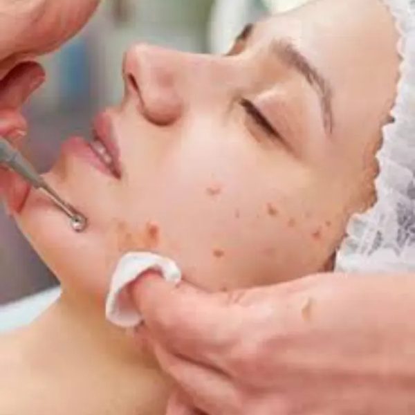Facial Acné
