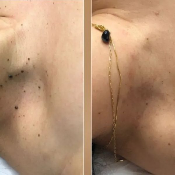 Nevus pen