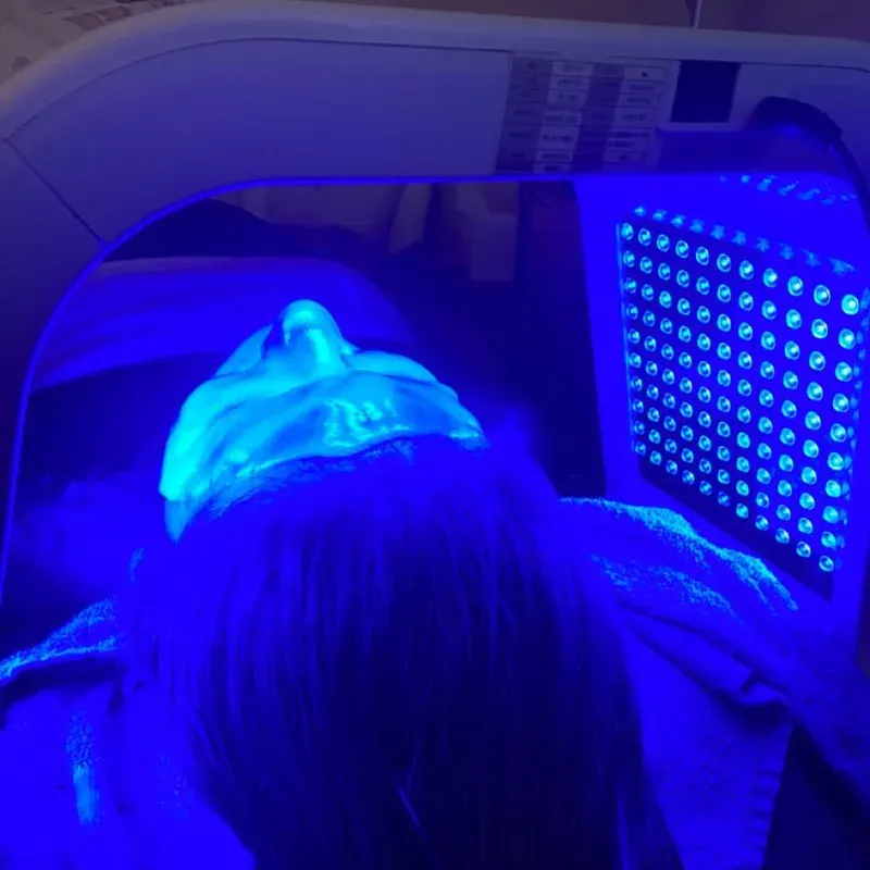 Biofotomodulación capilar