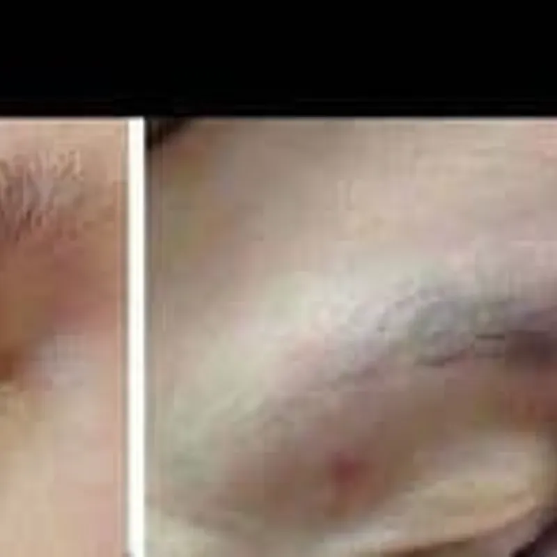 Cauterización de verrugas