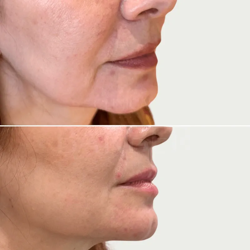 Relleno de Mandibula.