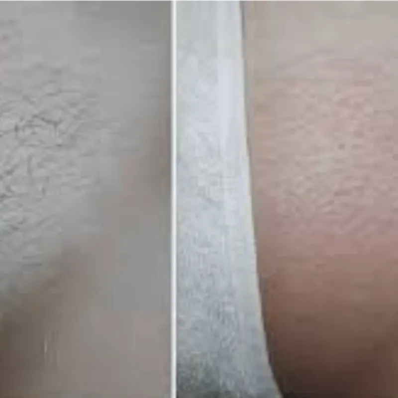 Depilación Brasileña