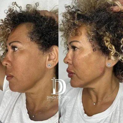 Marcación del Reborde Mandibular 