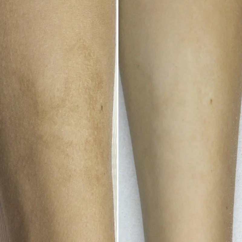 Terapia de microagujas para manchas