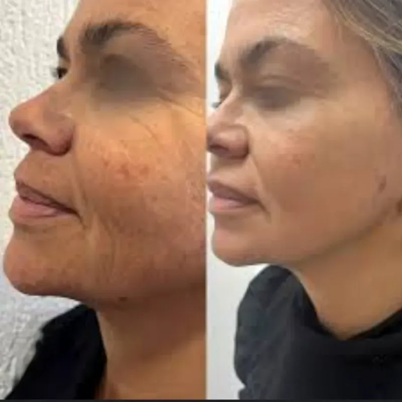 Hifu. (Ultrasonido Focalizado de Alta Intensidad )