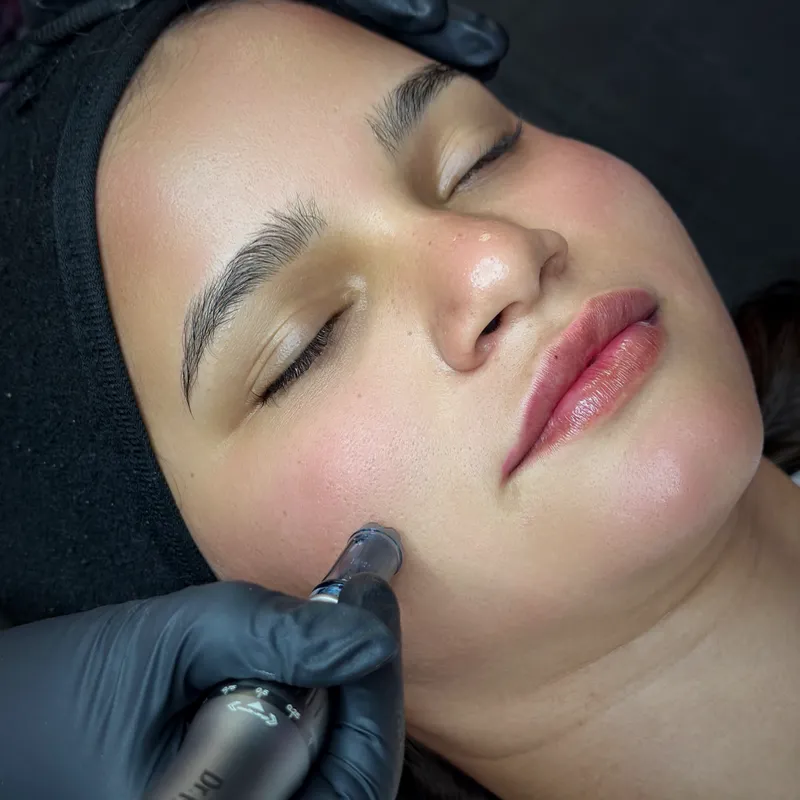 Microneedling con Dermapen