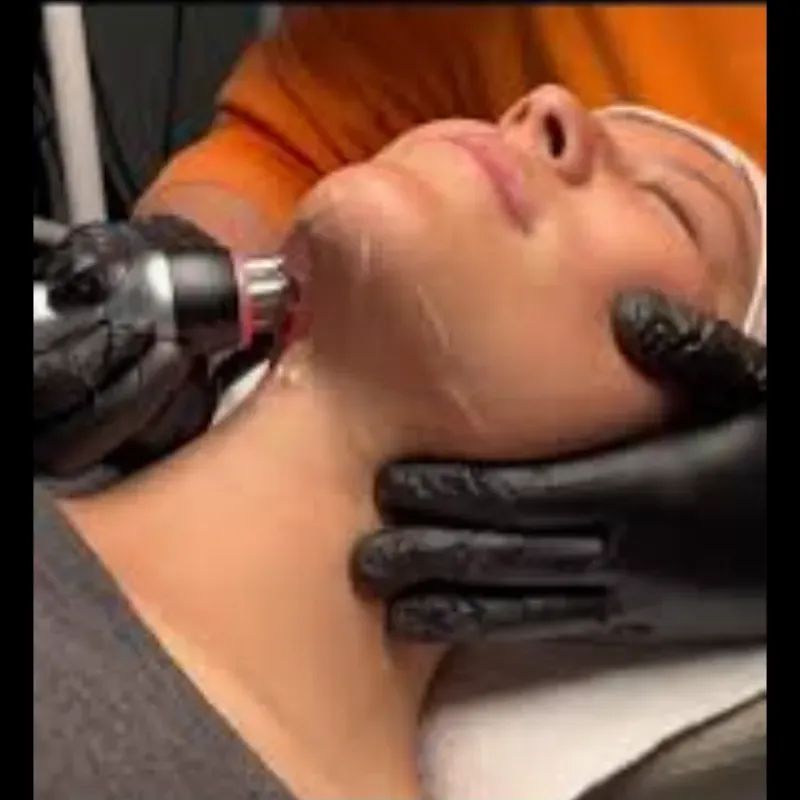 Radio frecuencia facial