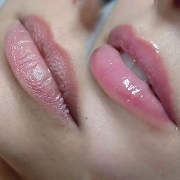 Hydralips
