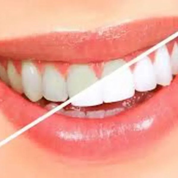 Curso BLANQUEAMIENTO DENTAL