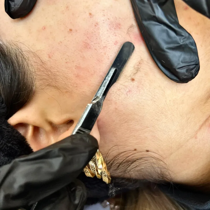 Dermaplaning