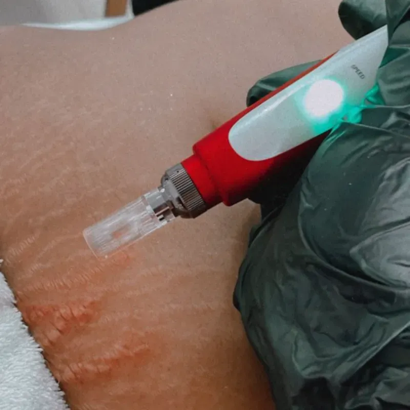 Tratamiento para las estrías