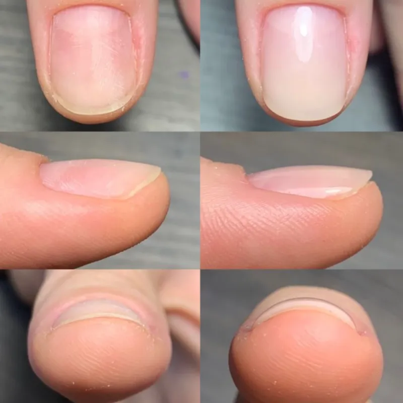 Reconstrucción de Uñas