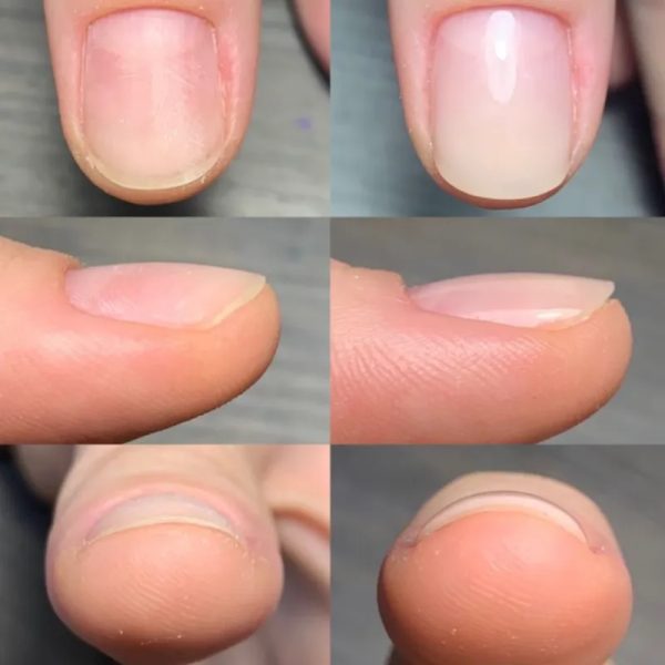 Reconstrucción de Uñas
