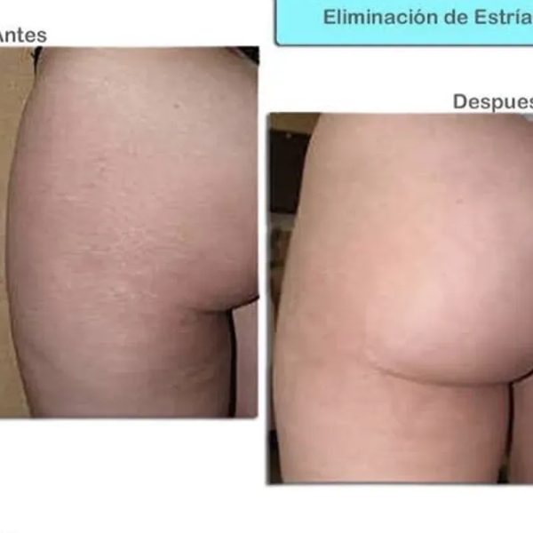 TRATAMIENTO DE ESTRÍAS EN GLÚTEOS