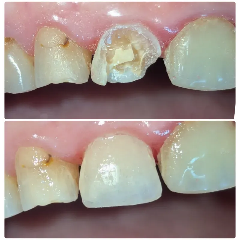 Restauración con Resina
