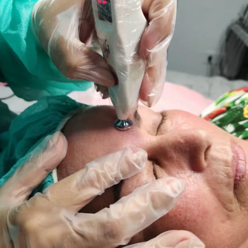 Electrolifting Facial