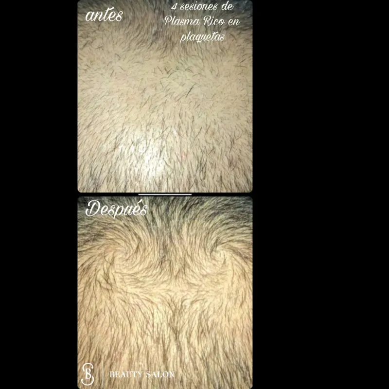 Plasma rico en plaquetas cuero cabelludo