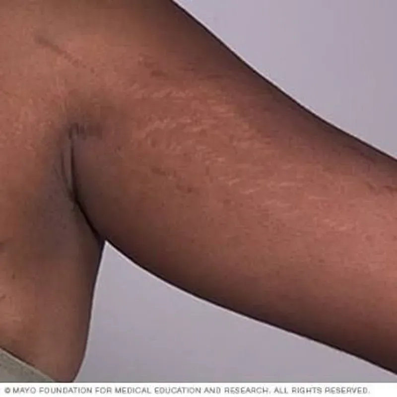 TRATAMIENTO DE ESTRÍAS EN BRAZOS