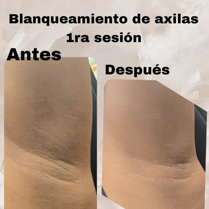 Blanqueamientos de piel por zonas