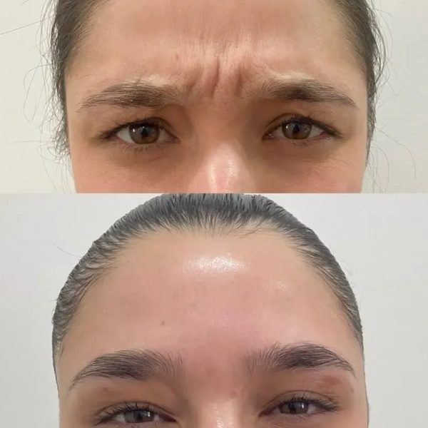 Bótox en Entrecejo 