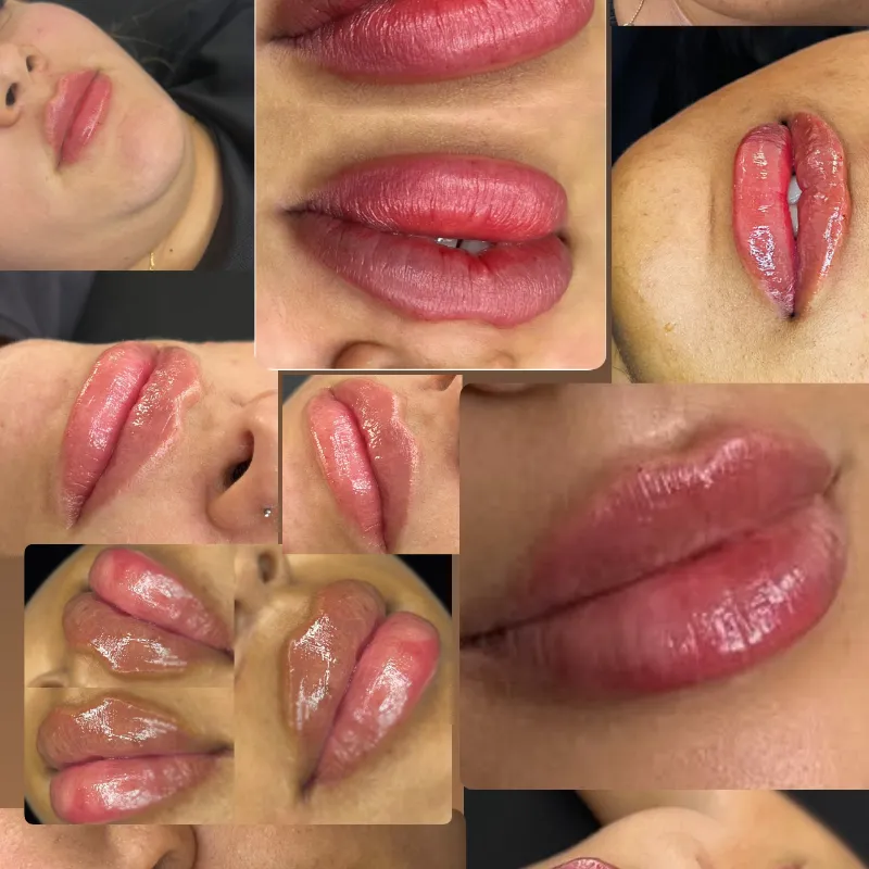 Relleno de Labios con Ácido Hialurónico