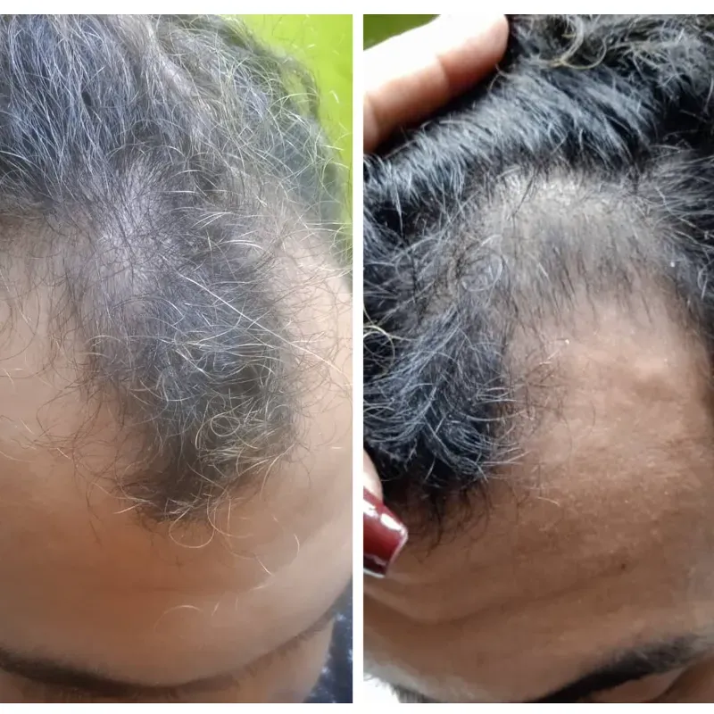 Anti alopecia PRP