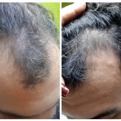 Anti alopecia PRP