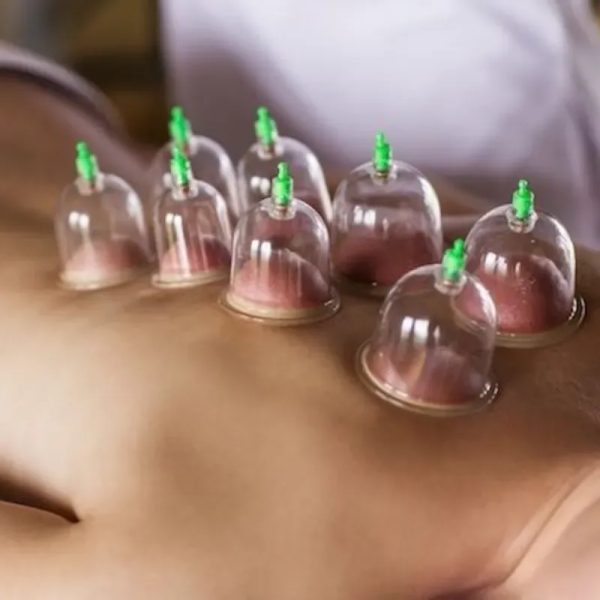 Terapia de ventosas