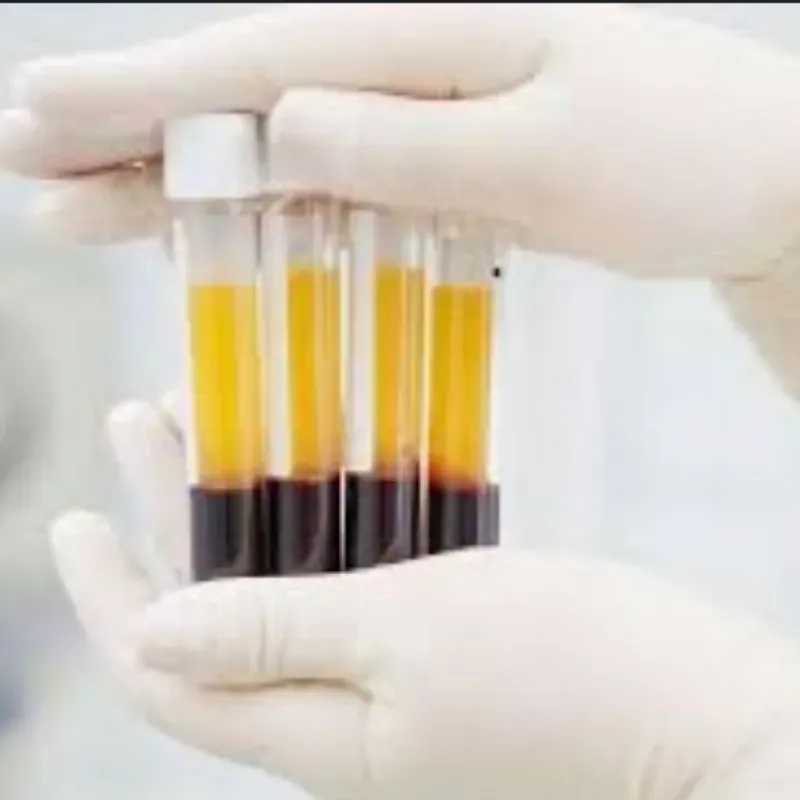 Plasma Rico en fibrina ( PRF)