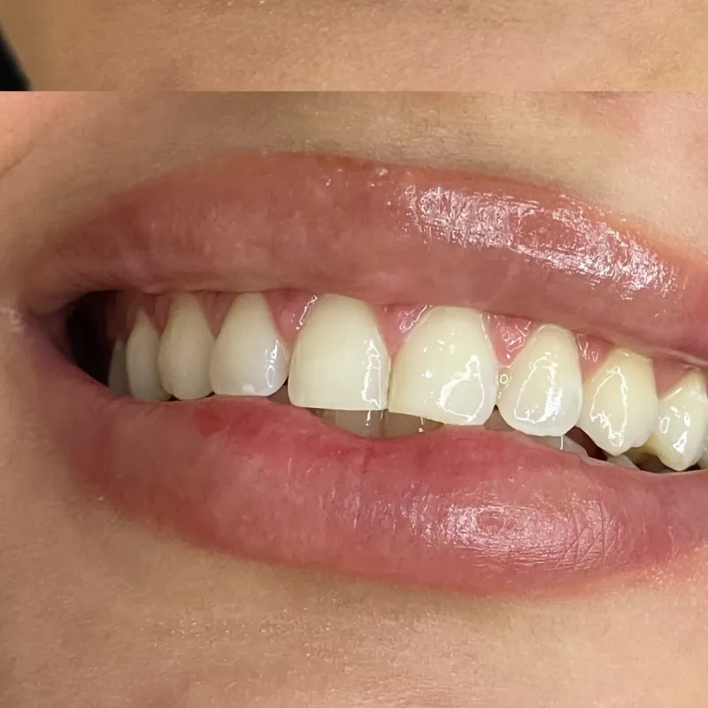 Blanqueamiento Dental con peróxido de carbamida 44%