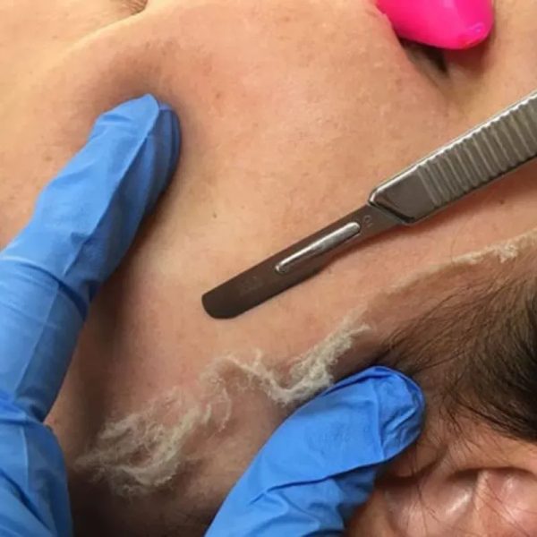 Dermaplaning.