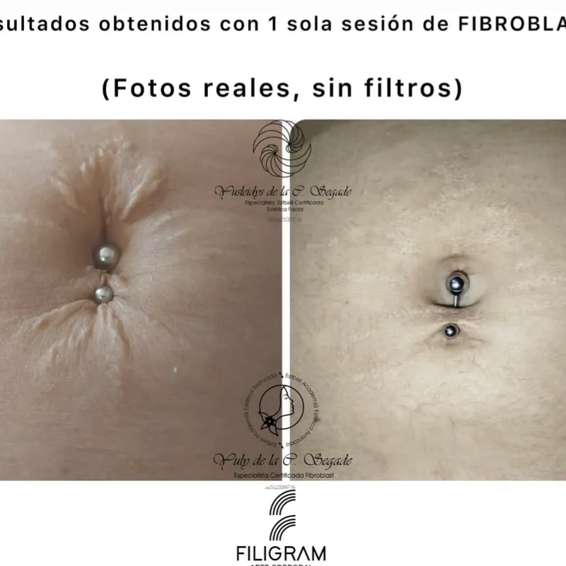 FIBROBLAST_Plasma Pen