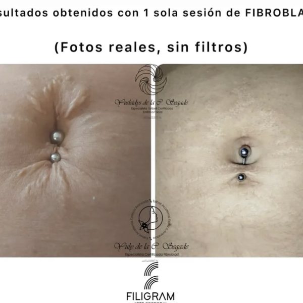 FIBROBLAST_Plasma Pen