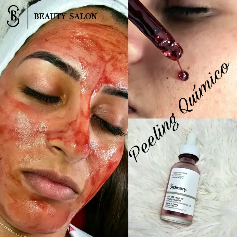 ✨Peeling Químico