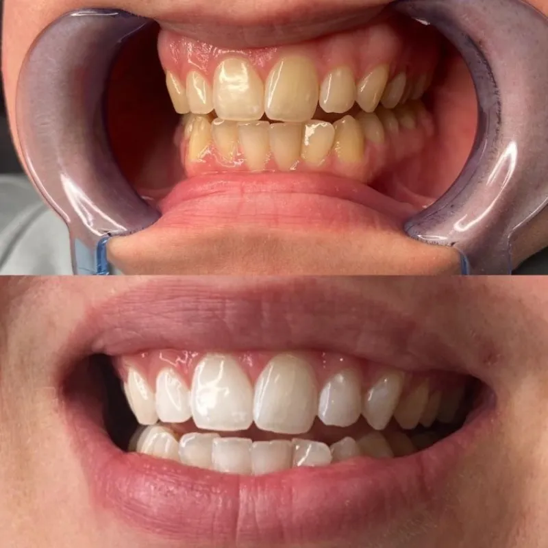 Limpieza Bucodental+Blanqueamiento dental+Laserterapia Gingival