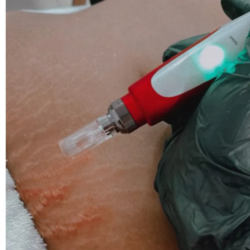 Estrías:láser picosecond azul + dermapen