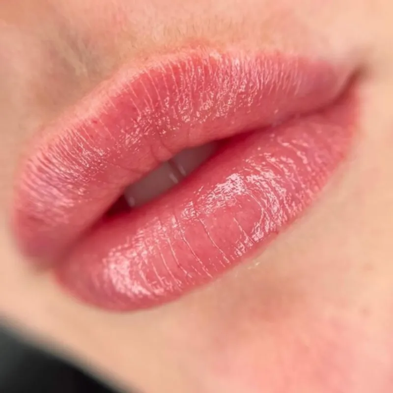 Microneedling de labios o Hydralips.