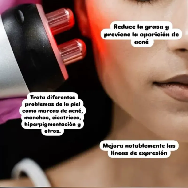 Radiofrecuencia facial