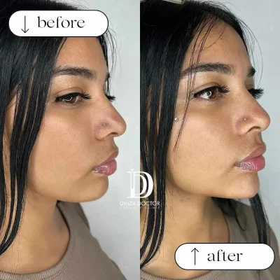 Proyección de Mentón 