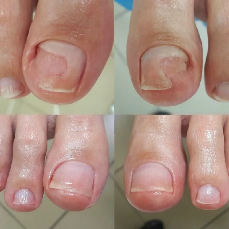 500 pesos  Reconstrucción de uñas