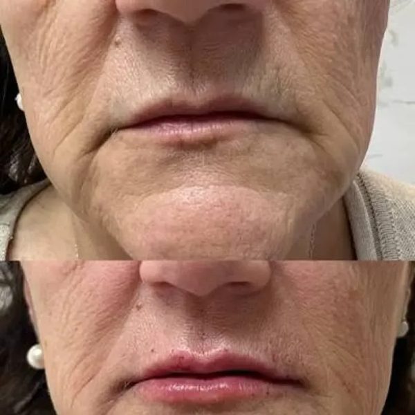 LIMPIEZA Y TRATAMIENTO FACIAL CON APARATOLOGIA COMPLETA