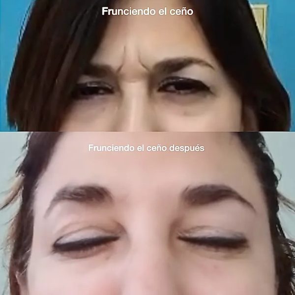 TOXINA BOT._BÓTOX