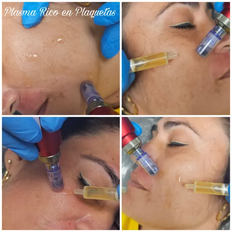 Plasma rico en plaquetas