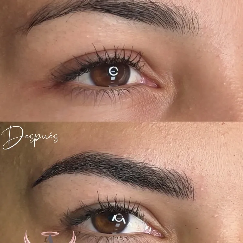 Retoque Después de 1 Año.