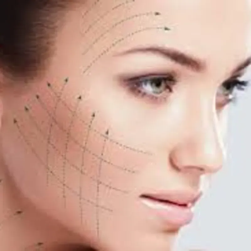 Taller PLASMALIFTING FRÌO E HILOS ESTÉTICOS REABSORBIBLES